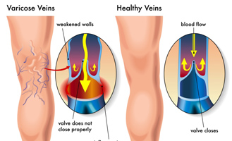 Varicose Veins, Ischemic Disorders