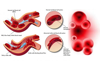 Anemia