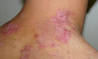 Chronic diseases