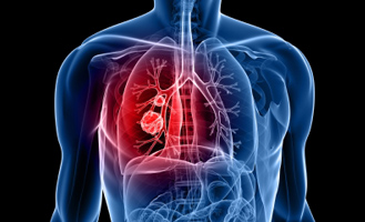 Respiratory Diseases