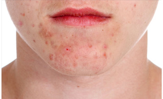 Skin Disorders